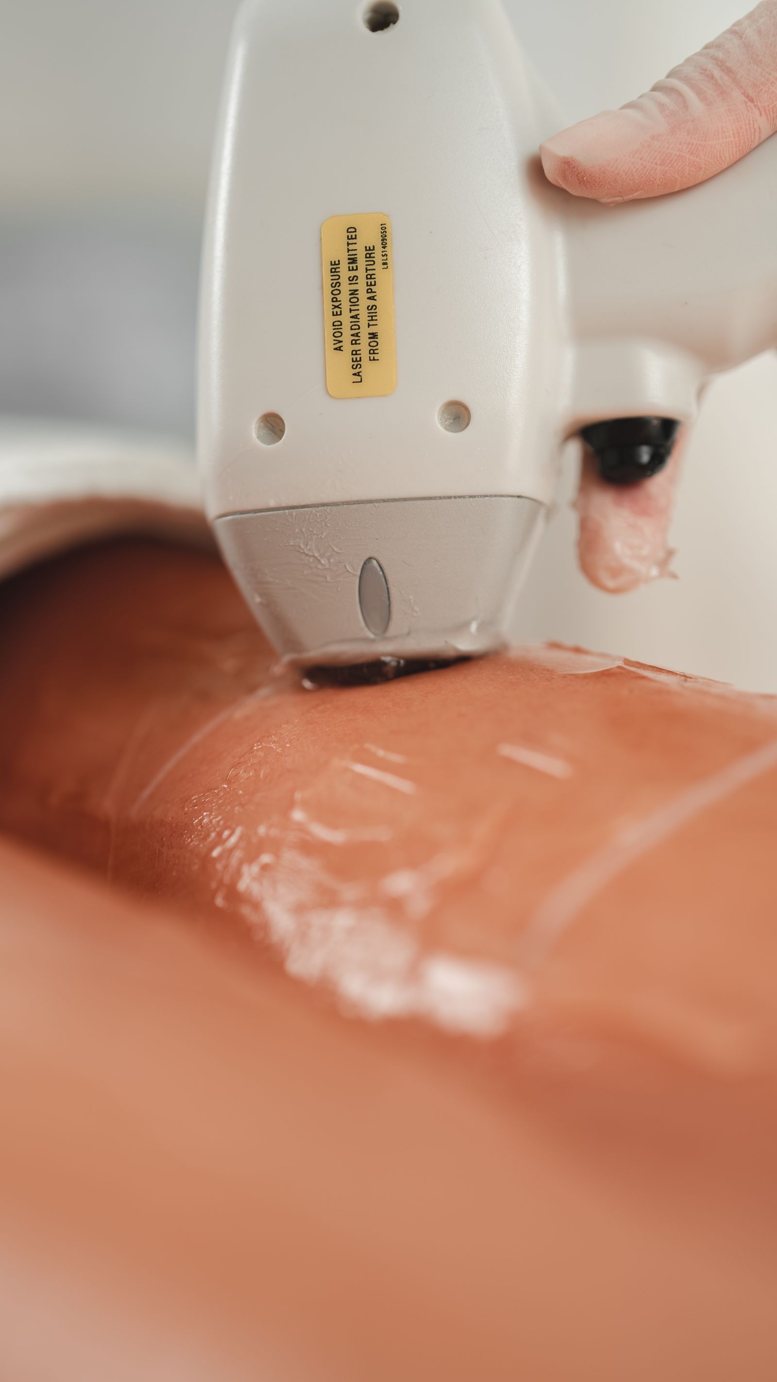 Close-up of a fractional laser handpiece resurfacing skin